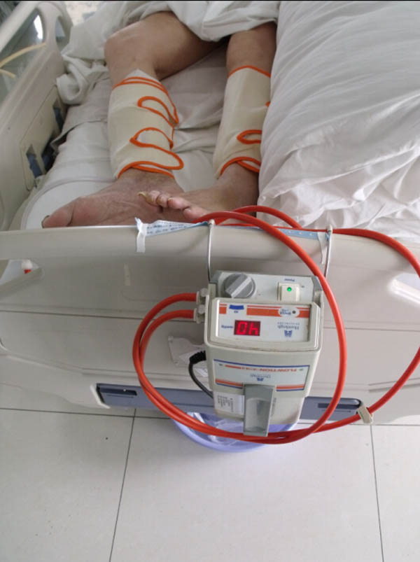 氣壓式血液循環(huán)驅動泵